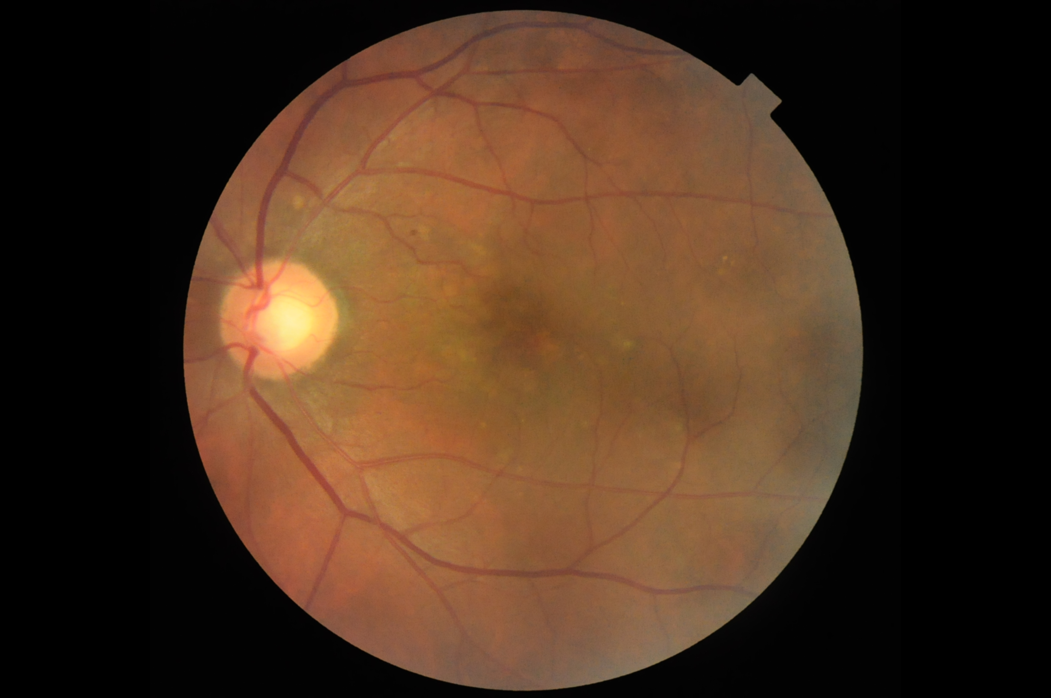 Imbalanced Multilabel Retinal Eye Disease classification